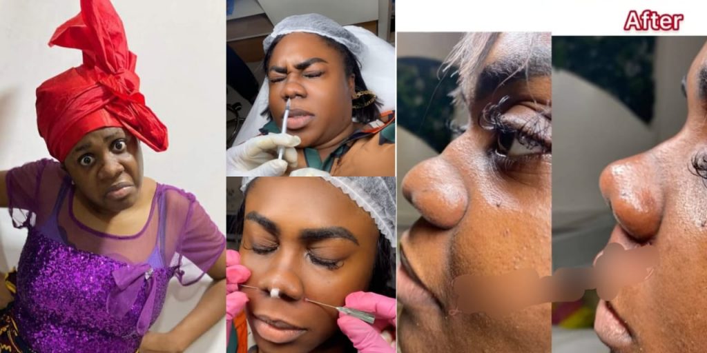 Netizens worried as skit maker ada jesus undergoing nose surgery to get a pointed nose 1024x512 1 | the9jafresh